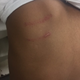 Jomaury Champ’s parents say these injuries across their son’s back were the result of a beating arranged by his 4th grade teacher